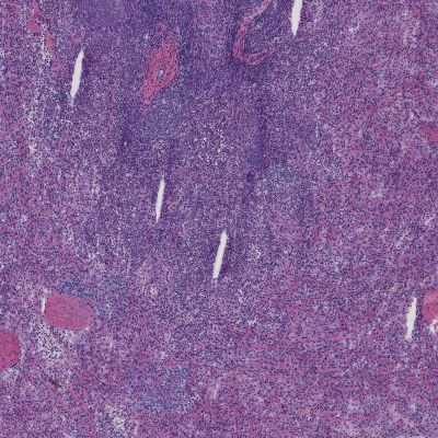 Spleen without FineFIX