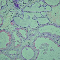 Benign breast tissue