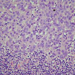 Metastatic breast tumor in lymphnode