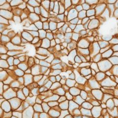 Breast cells HER2 amplification