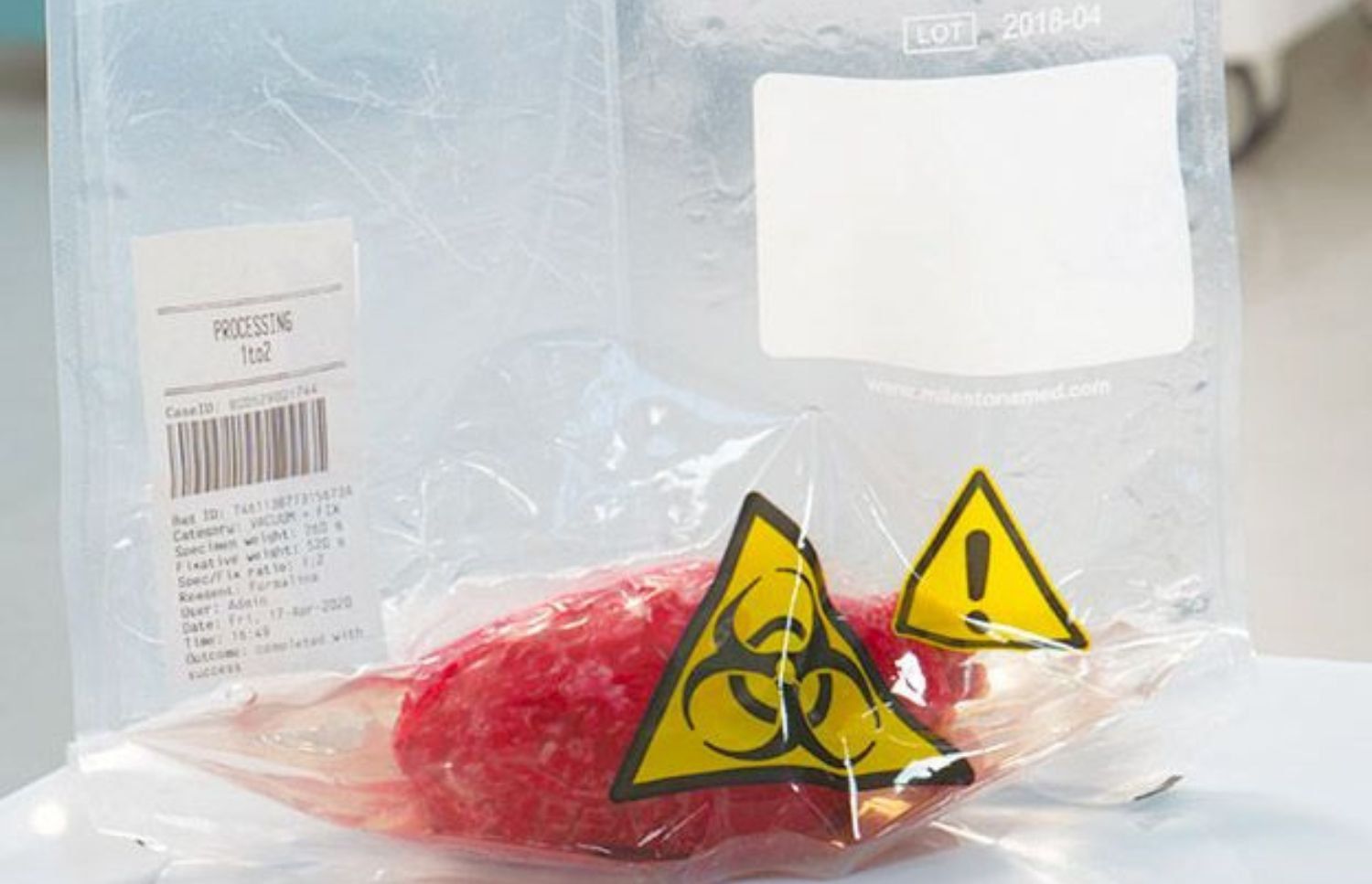 Health Impacts of Daily Formalin Exposure for Operating Room Nurses cover