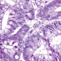 Colonic biopsy, H&E