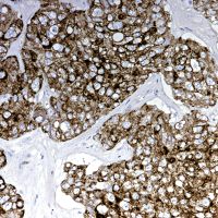 Adenocarcinoma, Cytokeratin CAM5.2